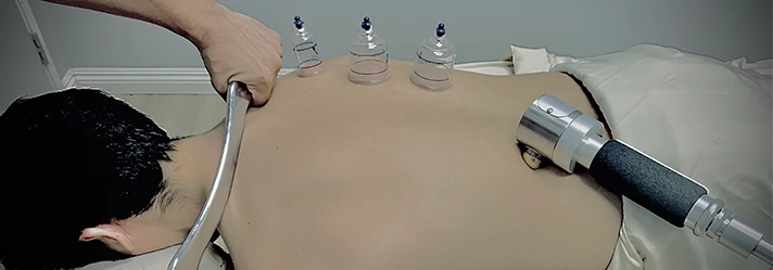 Chiropractic Downey CA Cupping Therapy